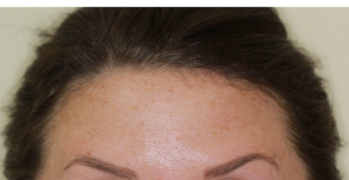 Botox3-After