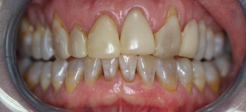 Porcelain-crowns6-Before